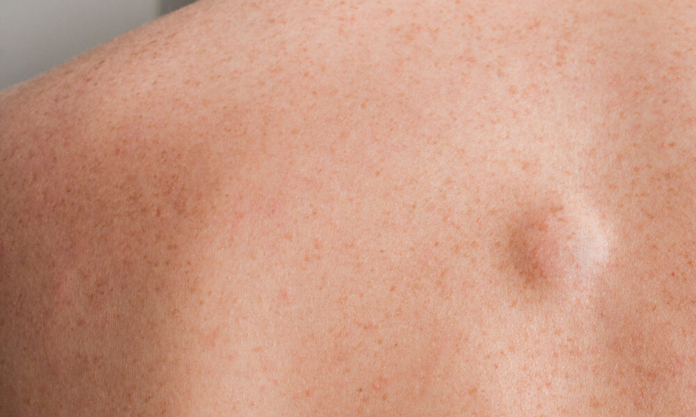 Podkažná tuková hrčka (Lipóm) – ako sa ho zbaviť?