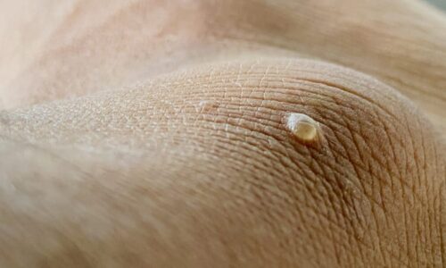 Bradavice, nepříjemný, ale běžný kožní problém. Jak se dají odstranit a kdy vyhledat lékaře?