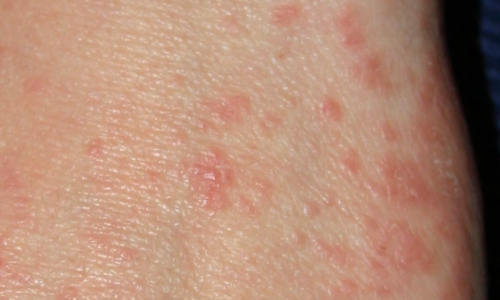 PŘEHLEDNĚ: Svrabem jsou ohroženy všechny skupiny. Jaké jsou příznaky a jak se bránit?