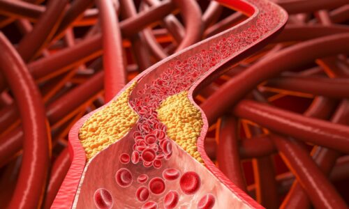 Neviditeľný nepriateľ v krvi. Ktorým mýtom o cholesterole odzvonilo?
