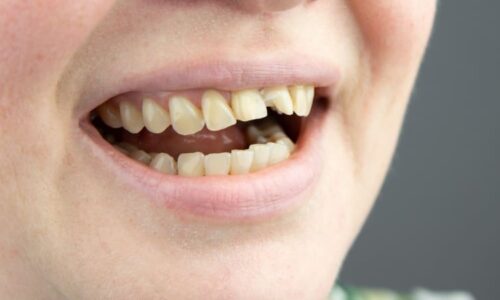 Příčiny žloutnutí zubů? Odborníci upozornili na šest chyb, které ničí bílý úsměv každý den