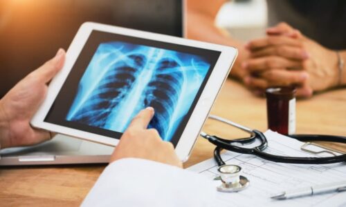 Revoluce v prevenci rakoviny plic: Britští vědci na zákeřnou nemoc chystají vakcínu